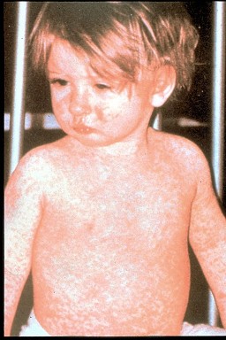 http://immunizebc.ca/diseases-vaccinations/measles